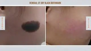 Reiki Angel Number for Removal of any black birthmark || किसी भी काले जन्मचिह्न को हटाना ||
