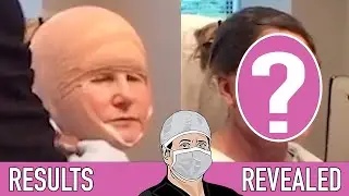 Facelift Before and After: Plastic Surgery Goals