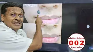 மச்சம் குறித்த மருத்துவ தகவல்கள் | how to remove unwanted mole in skin? | dr karthikeyan youtube