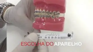 Forsus - Prof. Dr. Pedro Andrade Jr.