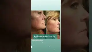 Reduce Wrinkles,easy to get with just 1 spoon of Liquid Biocell.Just DM for details. #collagen #skin