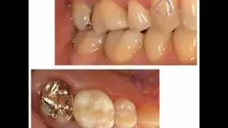 ROE Dental Laboratory - emax pressed, stacked, veneered, milled, you name it