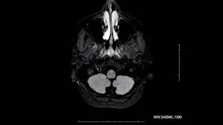 Revolutionizing Multiple Sclerosis Diagnosis:How Quantib Brain Enhances MRI Analysis.(1)