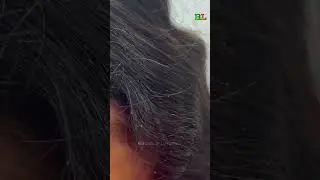 Bye-Bye Lice!✨ Tea Tree Shampoo for a Fresh, Healthy Scalp!