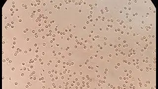 Azoospermia : sperm retrieval