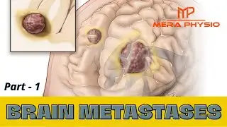 Brain Metastases - part 1 | Introduction | In Hindi | Mera Physio