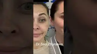 Botox filler threads