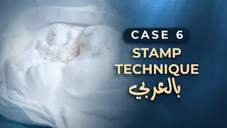 Stamp Technique بالعربي I Case 6