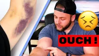 Does Donating Plasma Give You a Permanent Scar? | Permanent Scarring From Donating Plasma