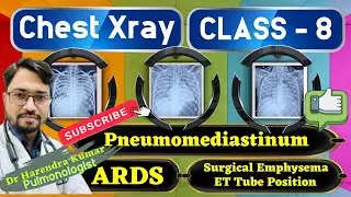 Chest  Xray Classes #8 (ARDS, ET Tube, Surgical Emphysema, Pneumomediastinum)