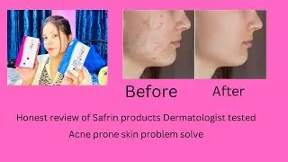 Honest Review of SAFRIN products || Dermaxil acne wipe cleanser || Dermaxil moisturizer