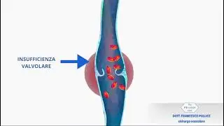 SCLEROTERAPIA a cura del Dott. Francesco Pollice, chirurgo vascolare