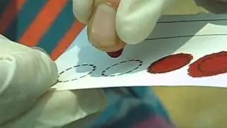 Dried Blood Spot Collection