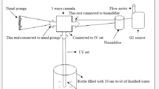 Indigenous Bubble CPAP (using 3-way cannula) for transport of babies with Respiratory Distress 
