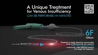 Vein Sealing System &ndash; VenaBlock &ndash; A Unique Treatment for Venous Insufficiency