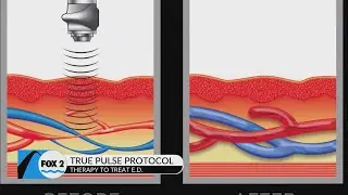 Pine View Medical Clinic offers needle and surgery-free solution to E.D.