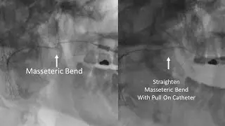 Stensens Duct Straighten Masseteric Bend