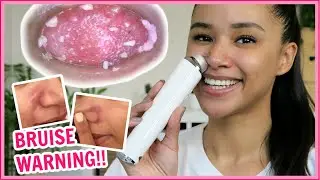 BLACKHEAD VACUUM WITH CAMERA REVIEW + skin damage warning! WATCH BEFORE YOU USE