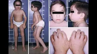 Hurler Scheie Syndrome; mucopolysaccharidosis type I MPS I represents an intermediate phenotype