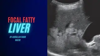 #sonography_of-focal-fatty_liver.||in-english)||By:Abdullah Noor wazir