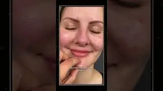 WARNING: The &ldquo;Pillow Face&rdquo; Epidemic | Filler Face Syndrome | Part 1 #facelift