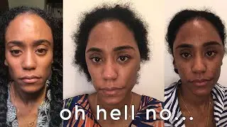 Hair Dye Allergy Almost Sent Me To The ER!!!!