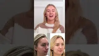 Kirsty&rsquo;s Acne Journey | Real Results & Clearer Skin at Este Medical Group