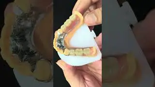 Metal Alloys Partial Cobalt Chrome Dentures Ivoclar Scheftner Comfortable Metal Framewrok