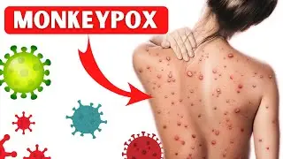 Monkeypox Causes, Symptoms and Treatment