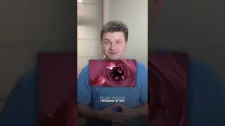 Перерождаются ли полипы в рак?  #проктолог #полипы #раккишечника