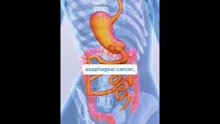 Esoguard Cancer Detection