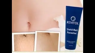 Best Stretch Mark Cream - See How Revitol's Stretch Mark Cream Helped Me Treat My Stretch Marks