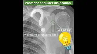 Posterior shoulder dislocation