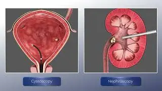 Enli8 CystoNephroscope