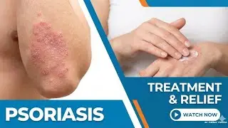 Psoriasis/cause/skincare/case-study/treatment Dr Fakher Fatima 