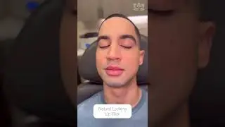 Lip Filler for Men: What to Expect Before and After