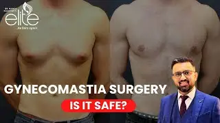 Liposuction & Gynecomastia Surgery in India &ndash; Safe or Risky? 🏥 | Expert Doctor Reveals All!