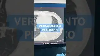 #toracentesi per #versamento #pleurico