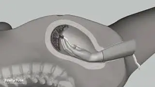 Vaginal Delivery: How to perform manual removal of the placenta (3D Animation)