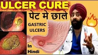 Rx Digestion #6 (Hindi) पेट मे अल्सर (छाले) Peptic, Gastric & Duodenal Ulcers | by Dr.Education