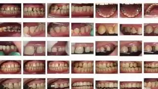 Invisalign Veneer Before and After case