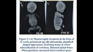 Thanatophoric dysplasia; lethal genetic skeletal disorder caused by mutations in the FGFR3 gene