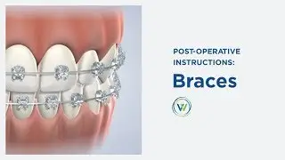 Braces Care Instructions in Arizona | Winterholler Implants & Restorative Dentistry