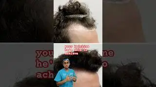 Receding hairline transplant #hairtransplantlondon #plasticsurgeon #hairtransplant
