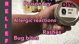 DIY Anti Itch Cream