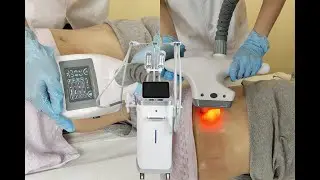 Cryolipolysis Velashape For Cellulite Treatment