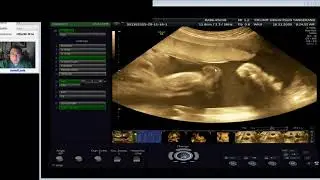 HYDRONEFROSIS GINJAL BILATERAL (Dr Wiku Andonotopo)