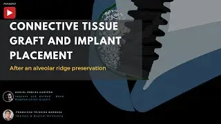 Implant Placement with Connective Tissue Graft