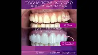 TROQUE SEU PROTOCOLO EM RESINA PARA PR&Oacute;TESE ZIRCONIA OU PORCELANA SOBRE IMPLANTE DENTARIO