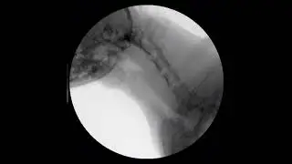 Canine mainstem bronchial and tracheal collapse (fluoroscopy)